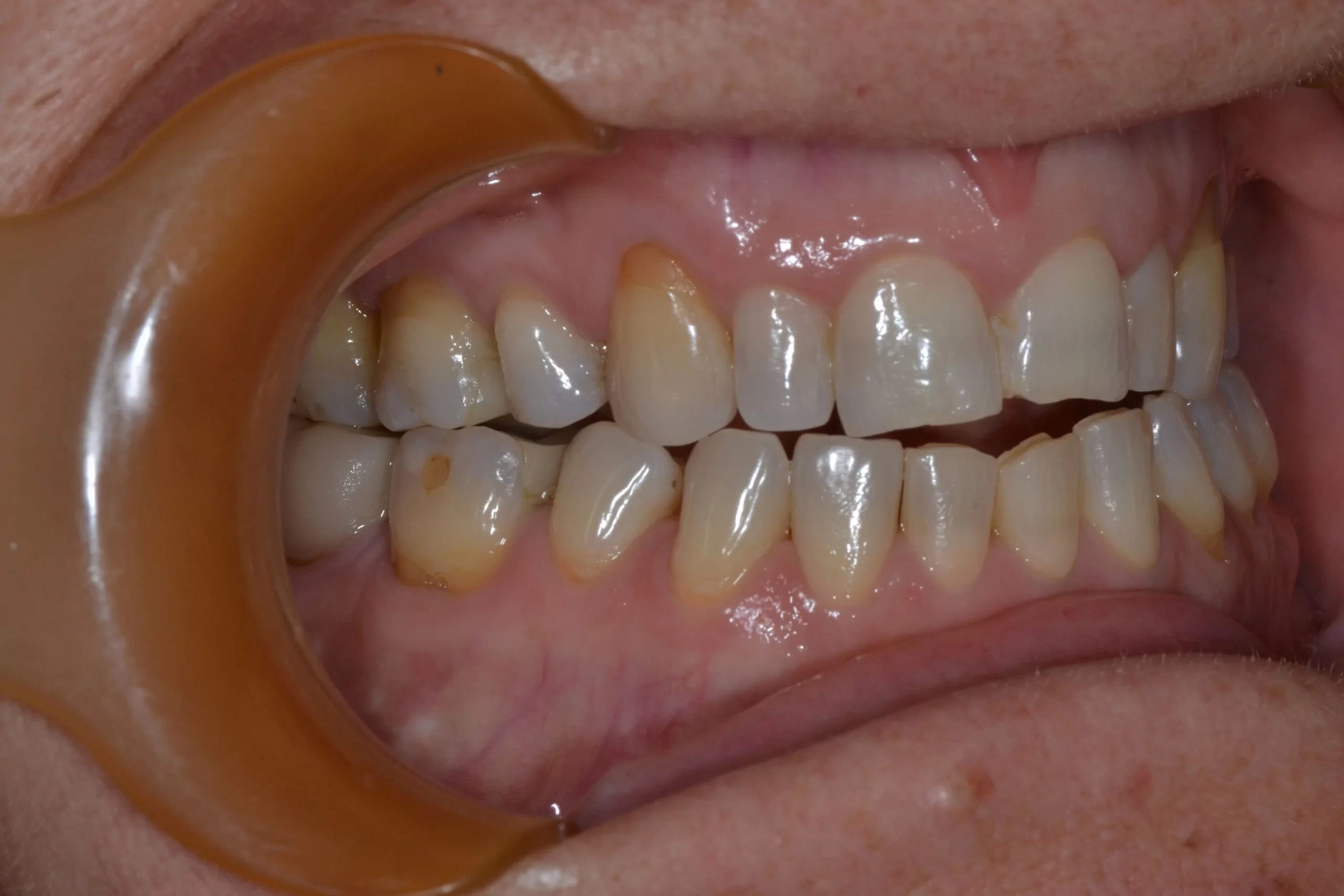 <span class="bt_bb_before_after_image_before_text">Before</span>