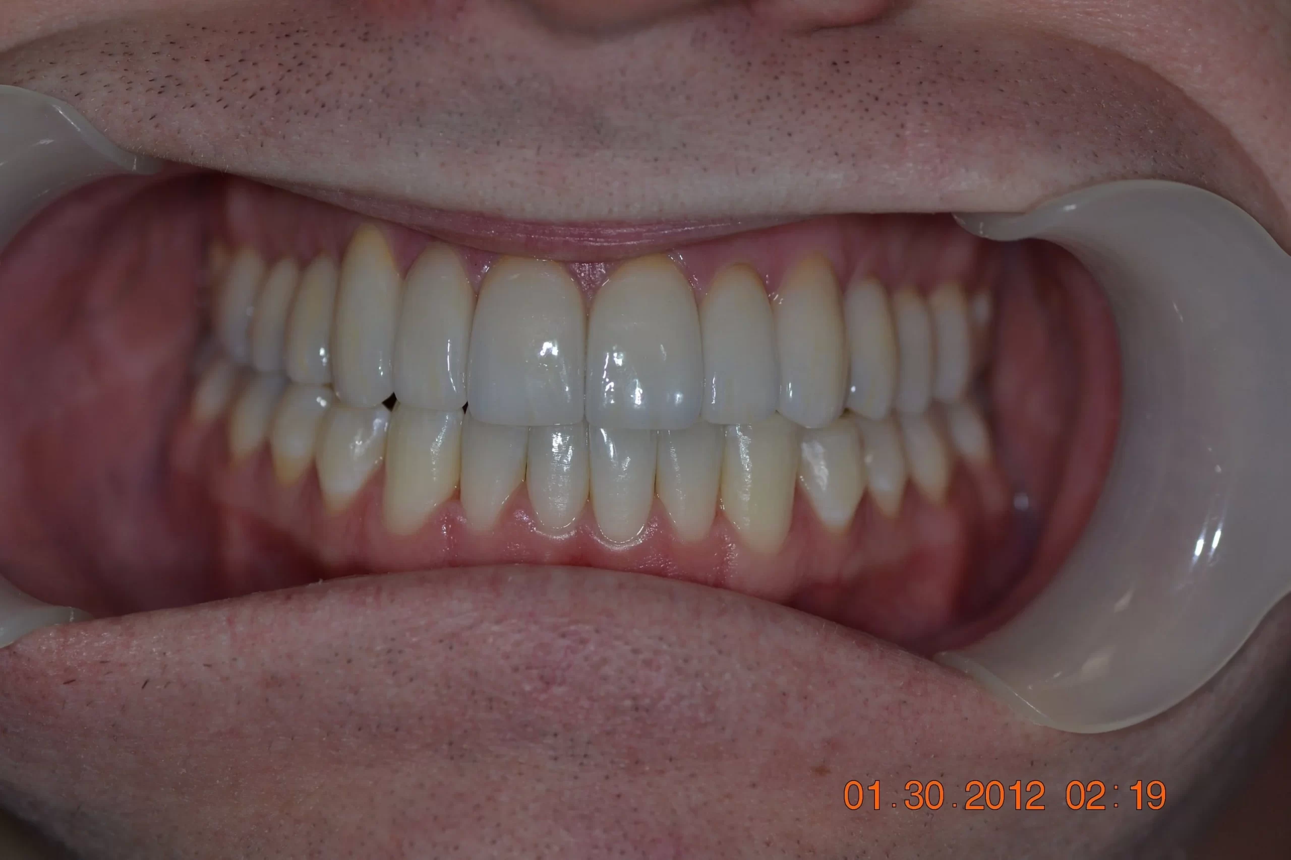 <span class="bt_bb_before_after_image_after_text">After</span>